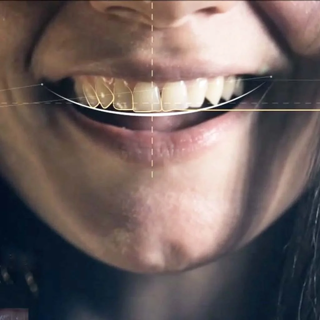 Digital Smile Designing